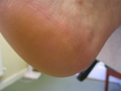 My heels are healed - no cracks